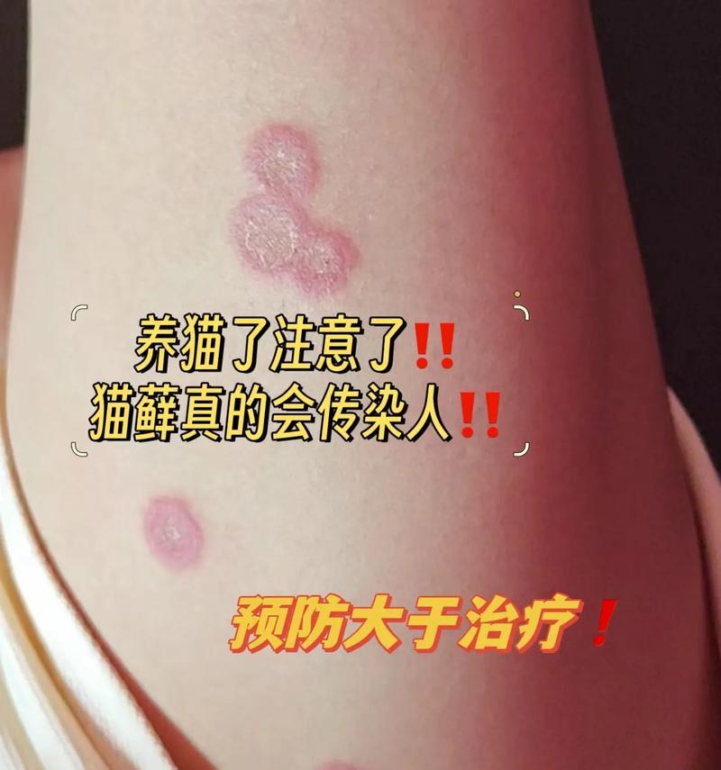 猫癣（揭示猫癣的发展过程与防治措施）