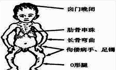 软骨病症状及相关信息（探寻软骨病的常见症状和治疗方案）
